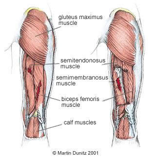 Torn Muscle Fibres